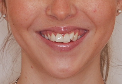 Operace čelisti před zákrokem