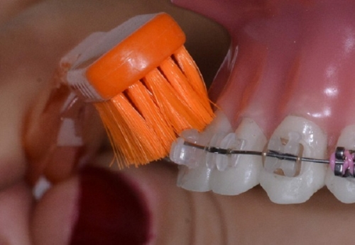 Čištění zubů s rovnátky