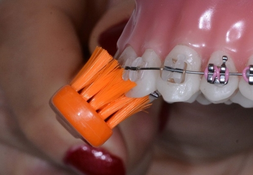 Čištění zubů s rovnátky