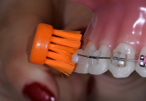 Čištění zubů s rovnátky