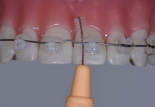 Čištění zubů s rovnátky