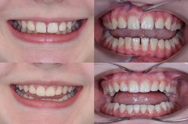 Výsledky léčby - pacient 1