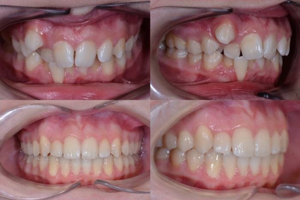 Výsledky léčby - pacient 2