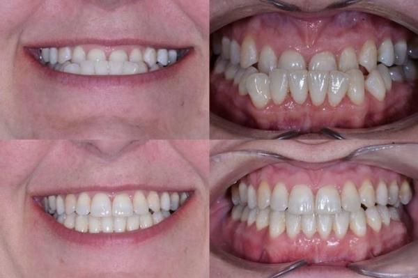 Výsledky léčby - pacient 3