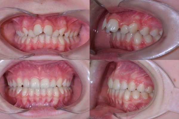 Výsledky léčby - pacient 4