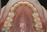 Lingual braces