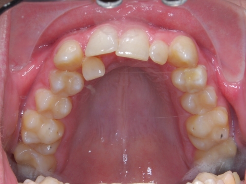 Samoligovací fixní aparáty