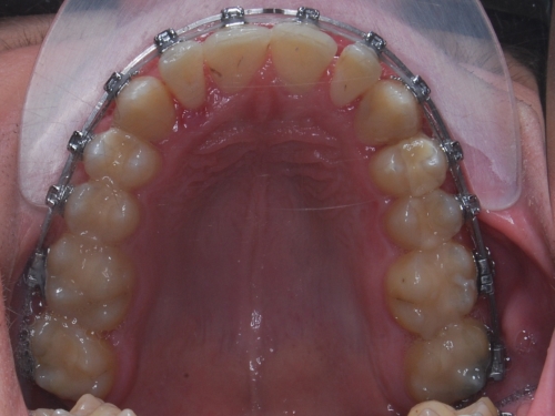 Samoligovací fixní aparáty