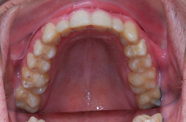 Samoligovací fixní aparáty